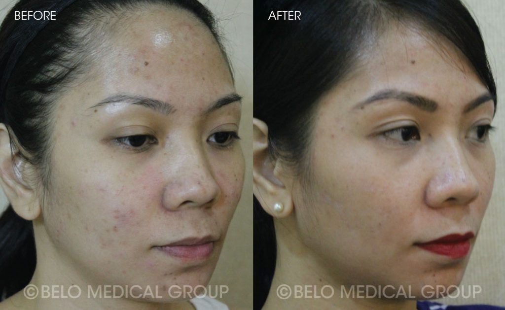 Belo Acne Program Before and After 5