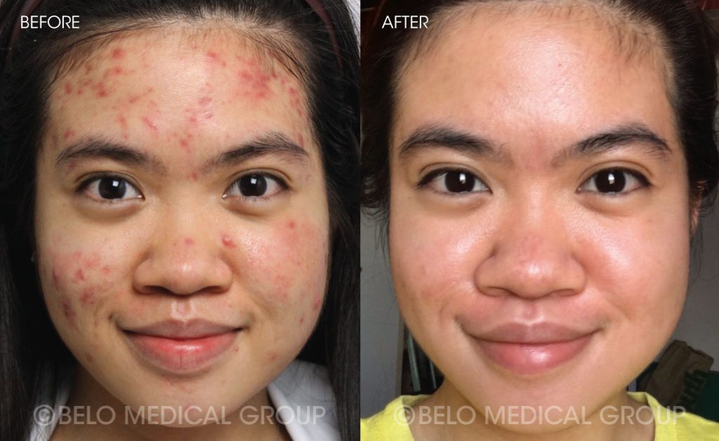 Belo Acne Program Before and After 2