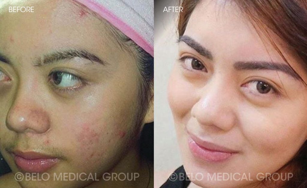 Belo Acne Program Before and After 4