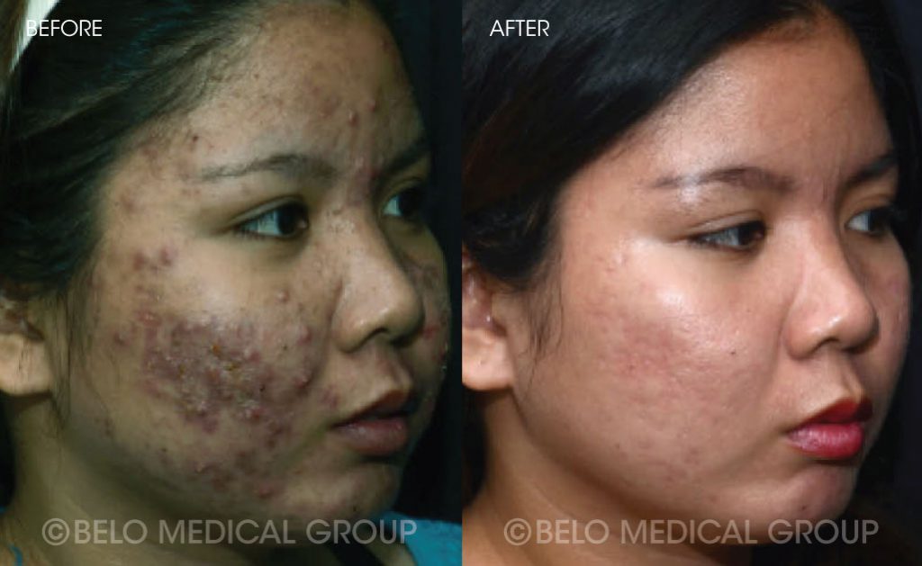 Belo Acne Program Before and After 1