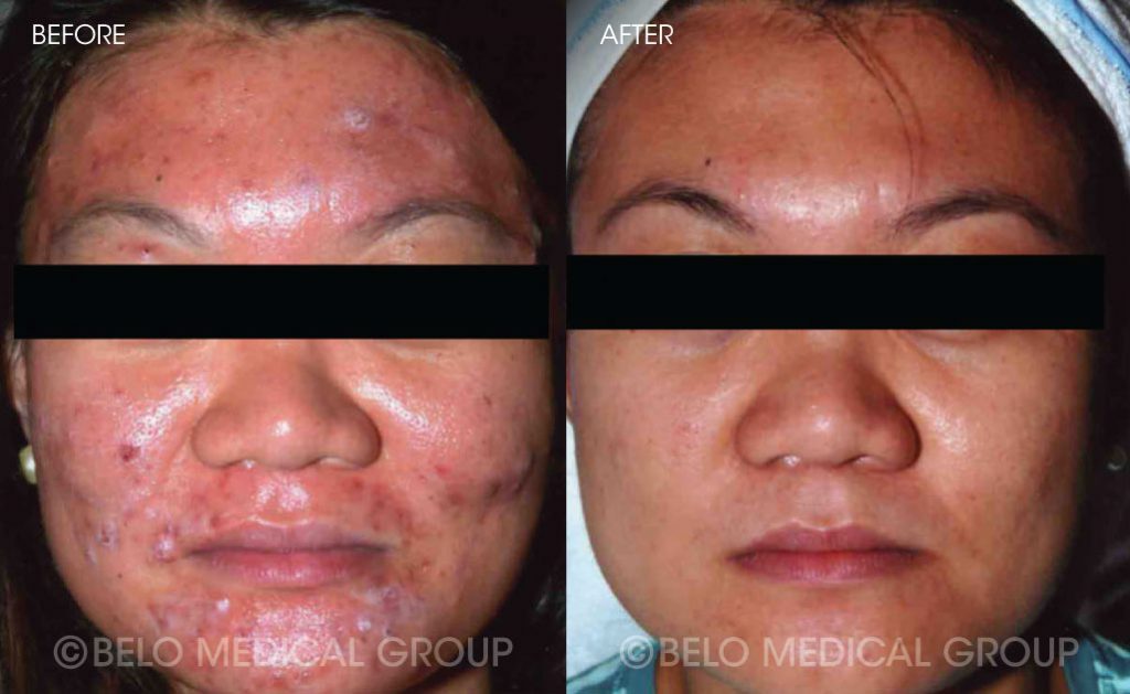 Belo Acne Program Before and After 3