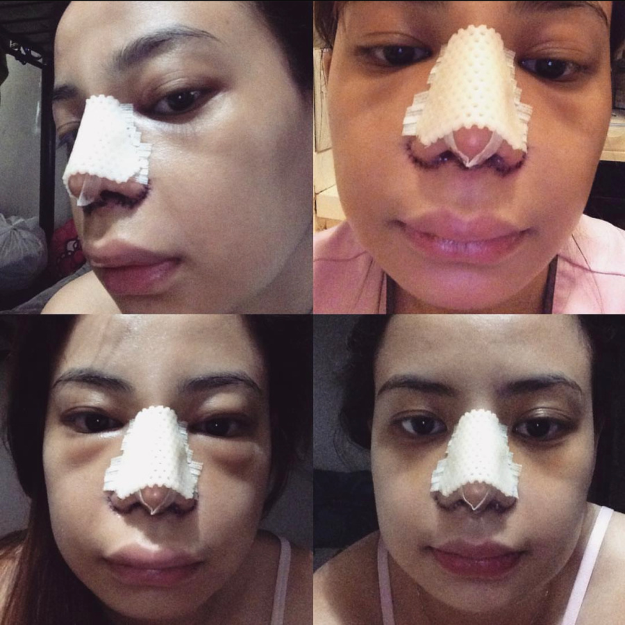 Sam Azul 1 Week After Rhinoplasty