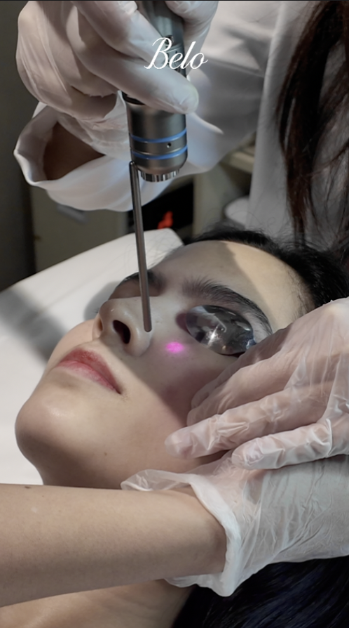 Angel Whitening Treatment for Panda Eyes