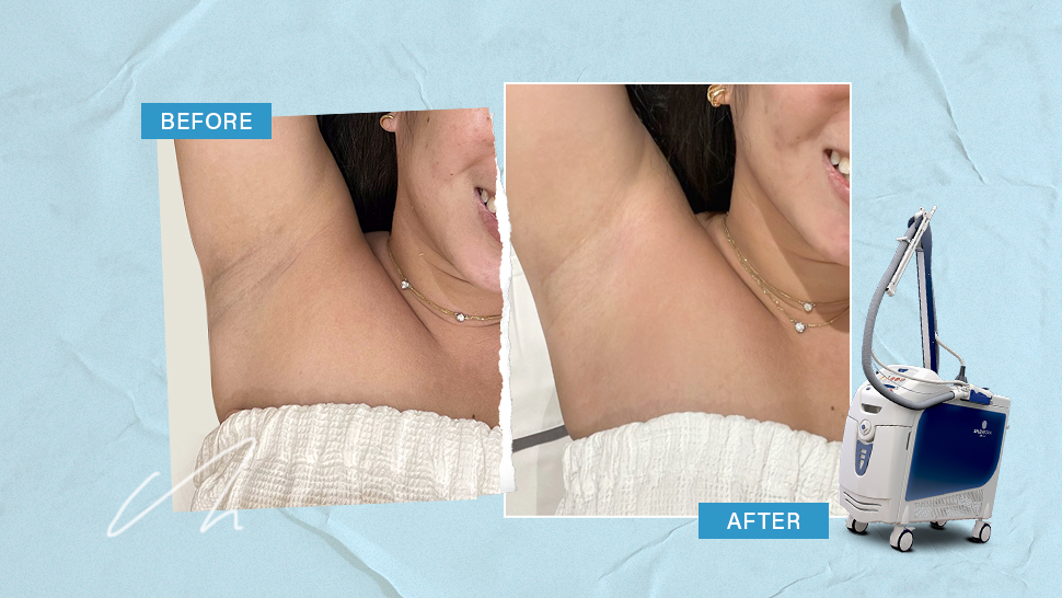 Splendor X Before and After Result