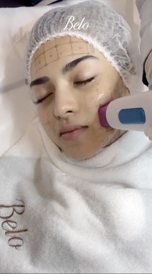 Mika Salamanca does Thermage FLX