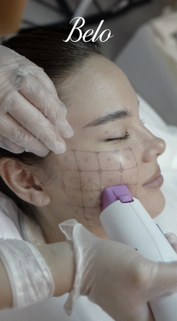 Catriona Gray does Thermage FLX