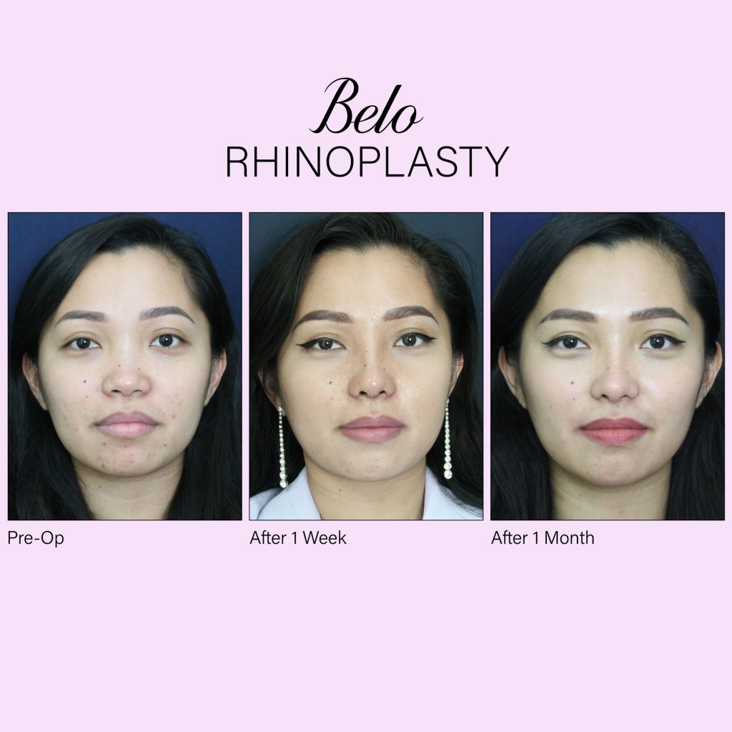 Belo Rhinoplasty Front View