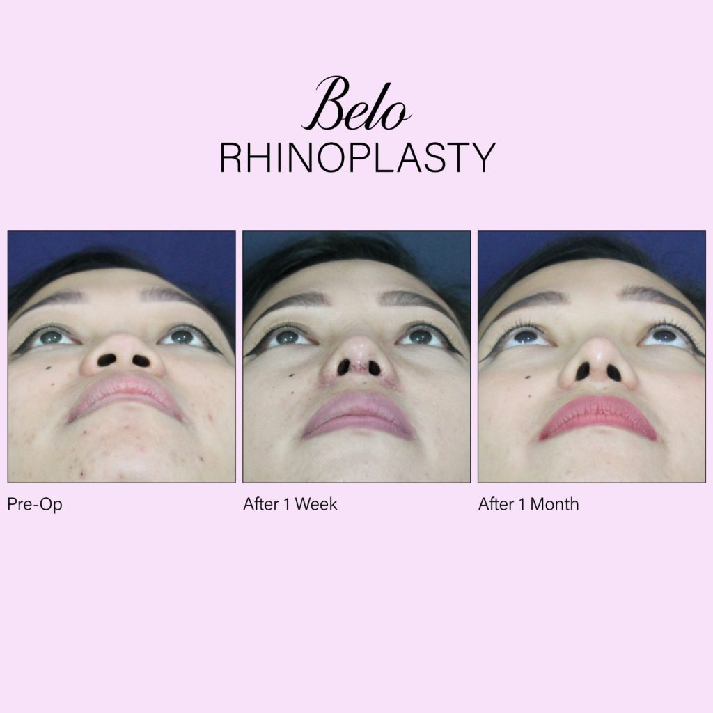 Belo Rhinoplasty Top View
