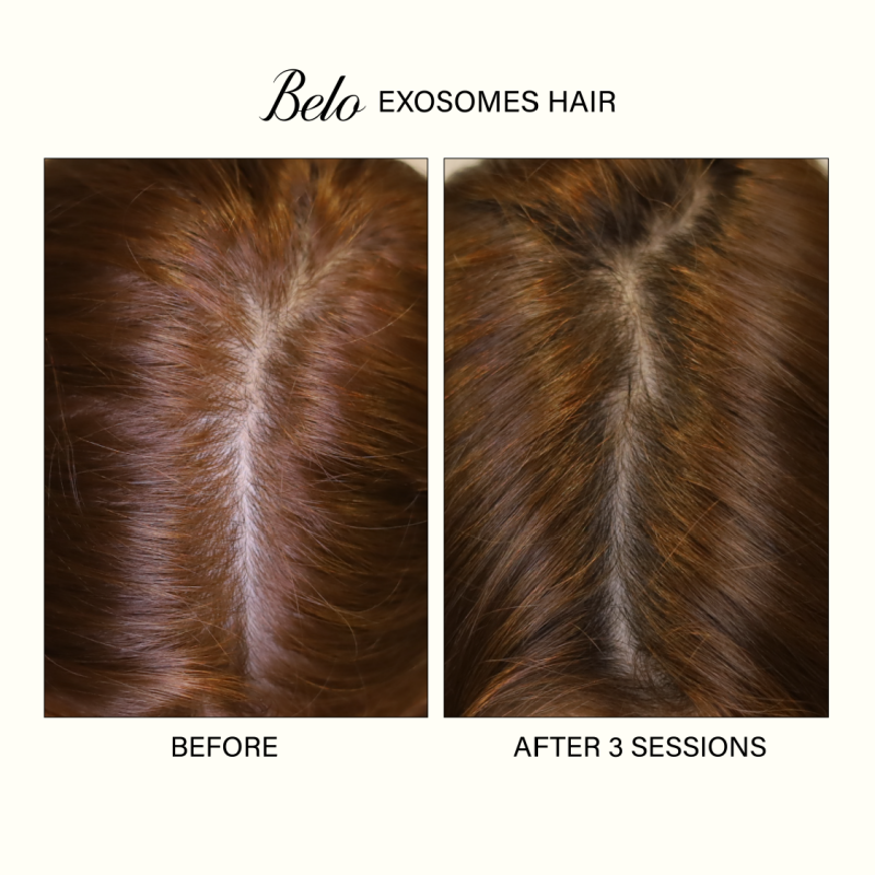 Before and After - ASCE+ Exosomes