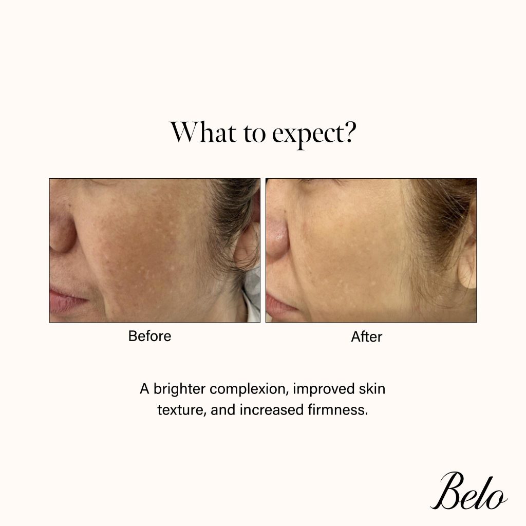 Before and After results