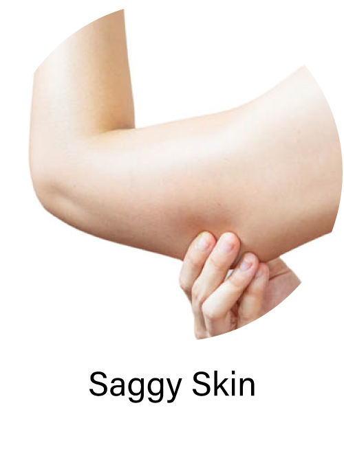Saggy Skin