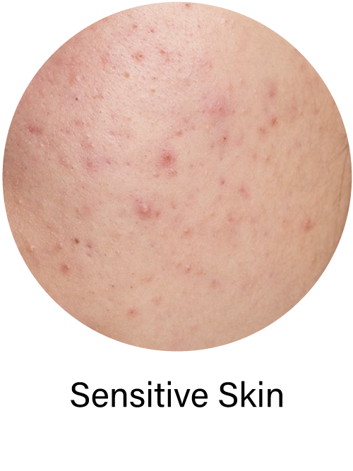 Sensitive Skin