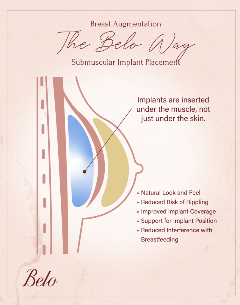 Breast Augmentation Belo Way