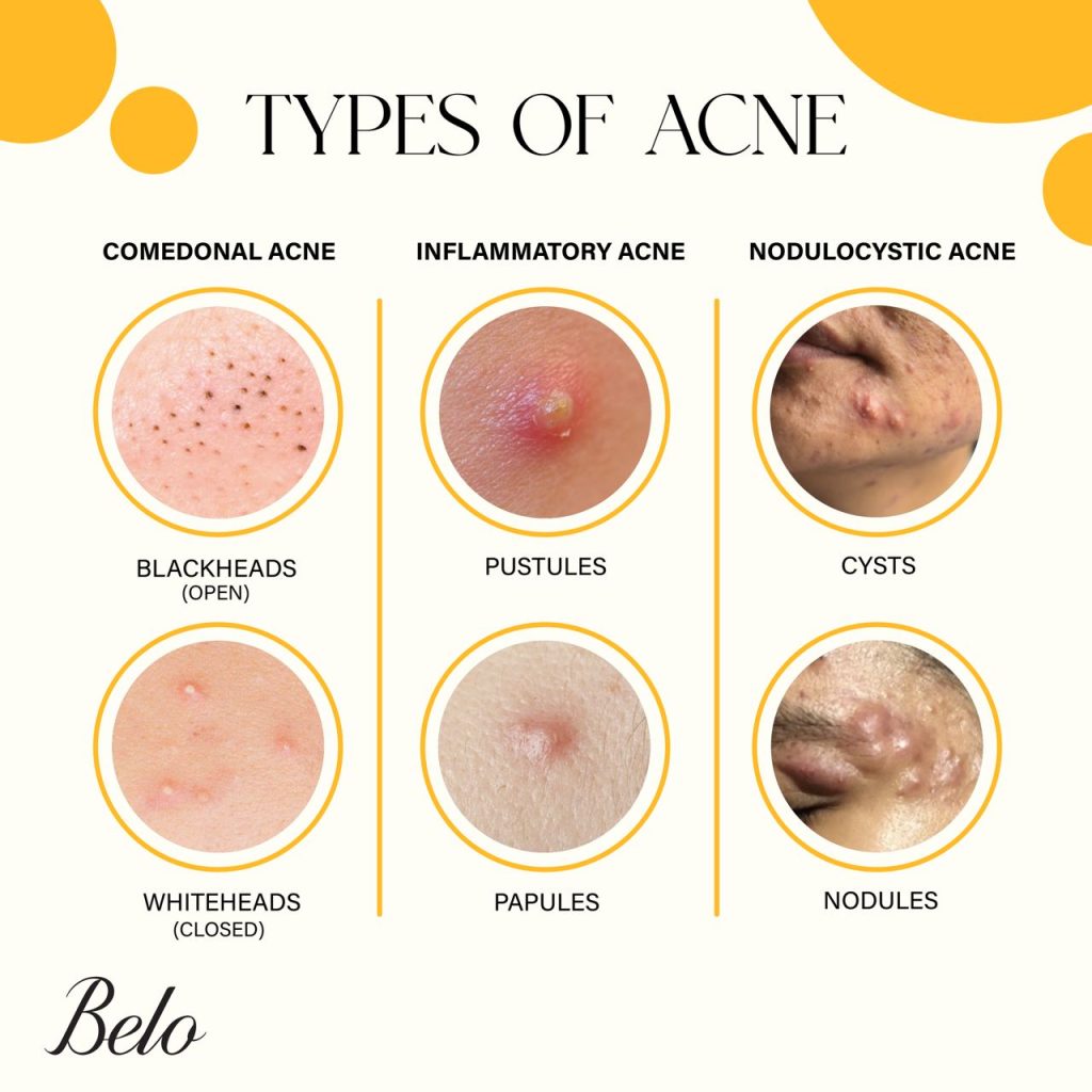 Types of Acne