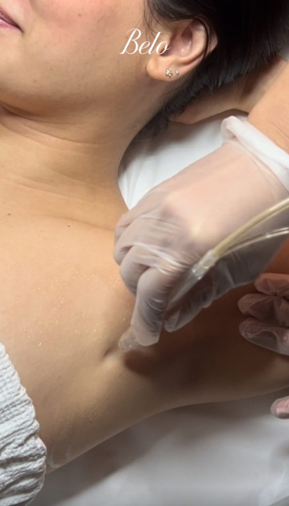 Belo Underarm Jetpeel