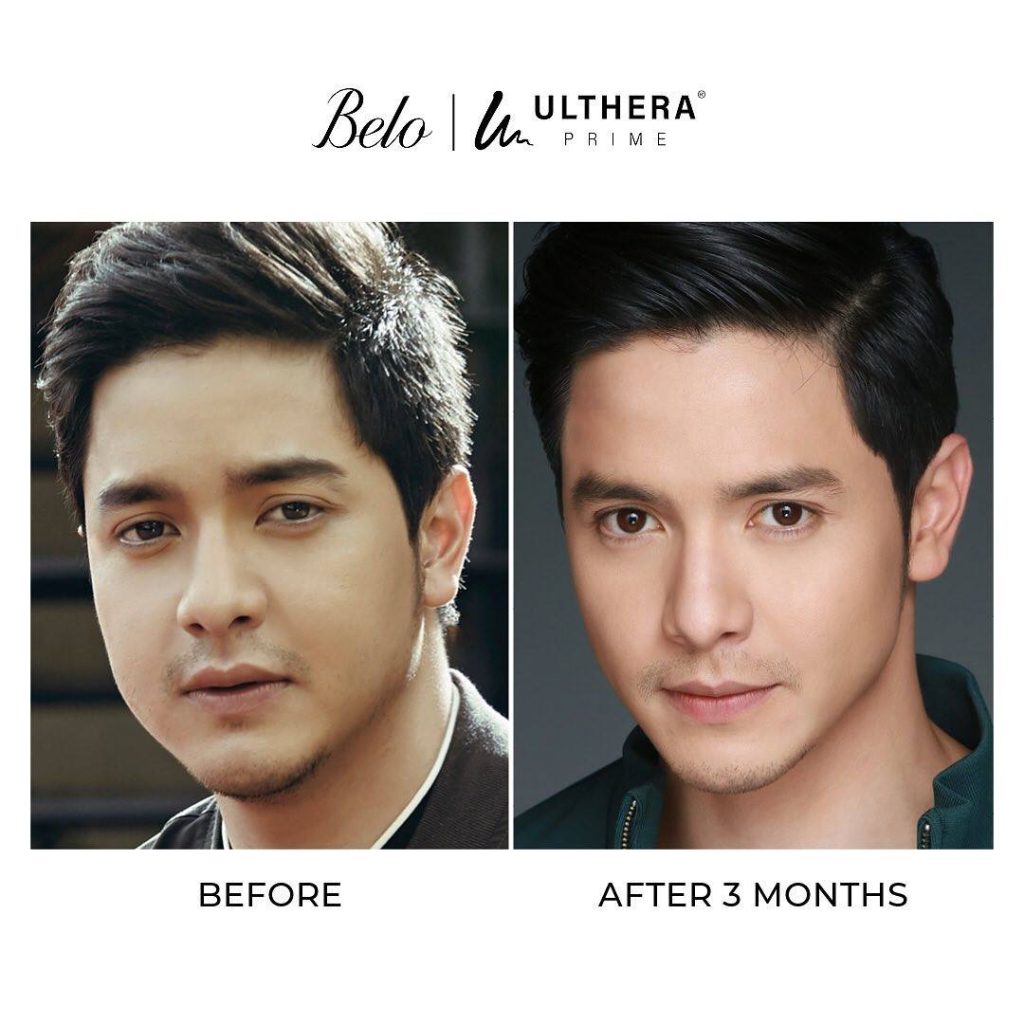 Alden Richards Before and After Ulthera Prime