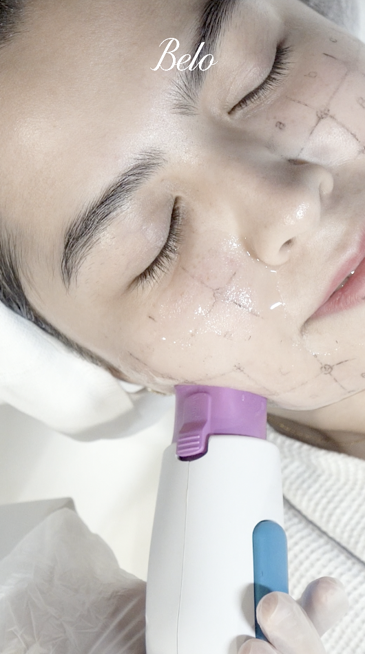 Alexa Ilacad does Thermage FLX