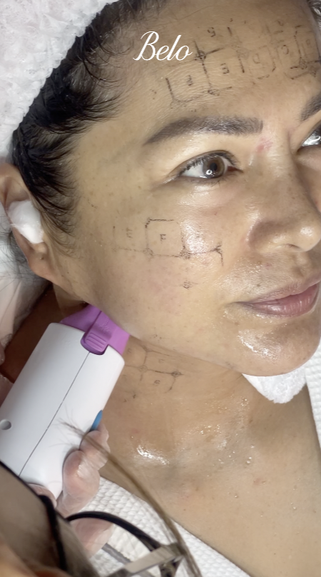 Alice Dixson does Thermage FLX
