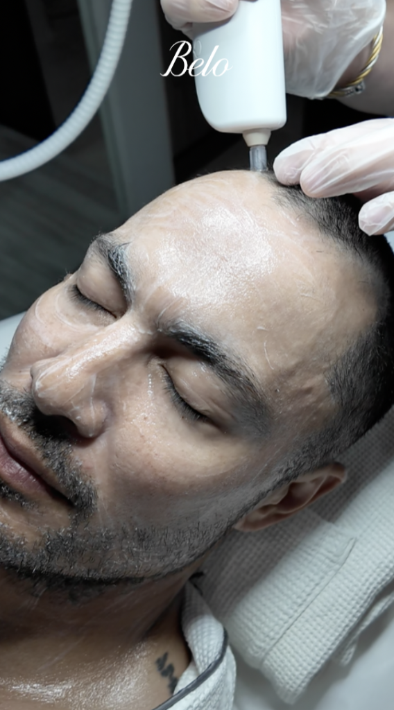 Exoscalp Treatment of Derek Ramsay