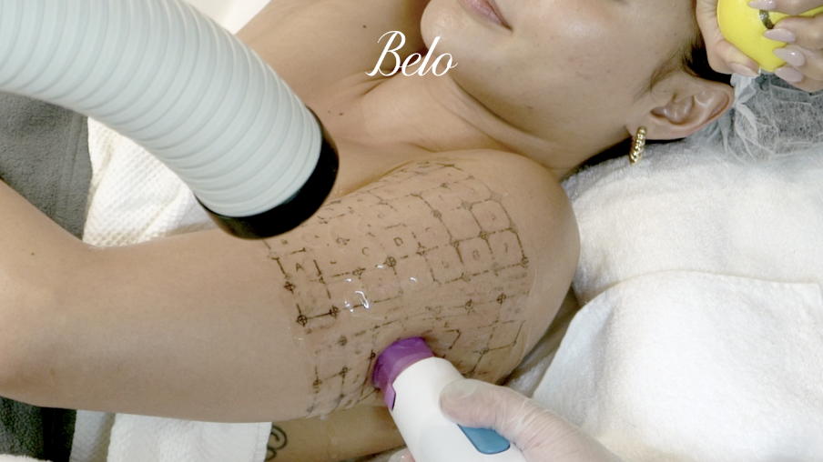 Lovi Poe - Thermage FLX