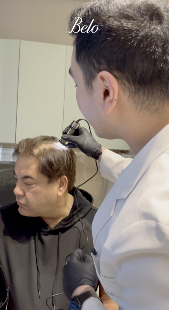 Exoscalp Treatment of Martin Nievera