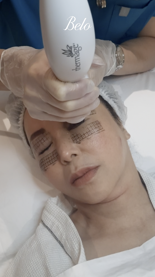 Small Laude - Thermage FLX