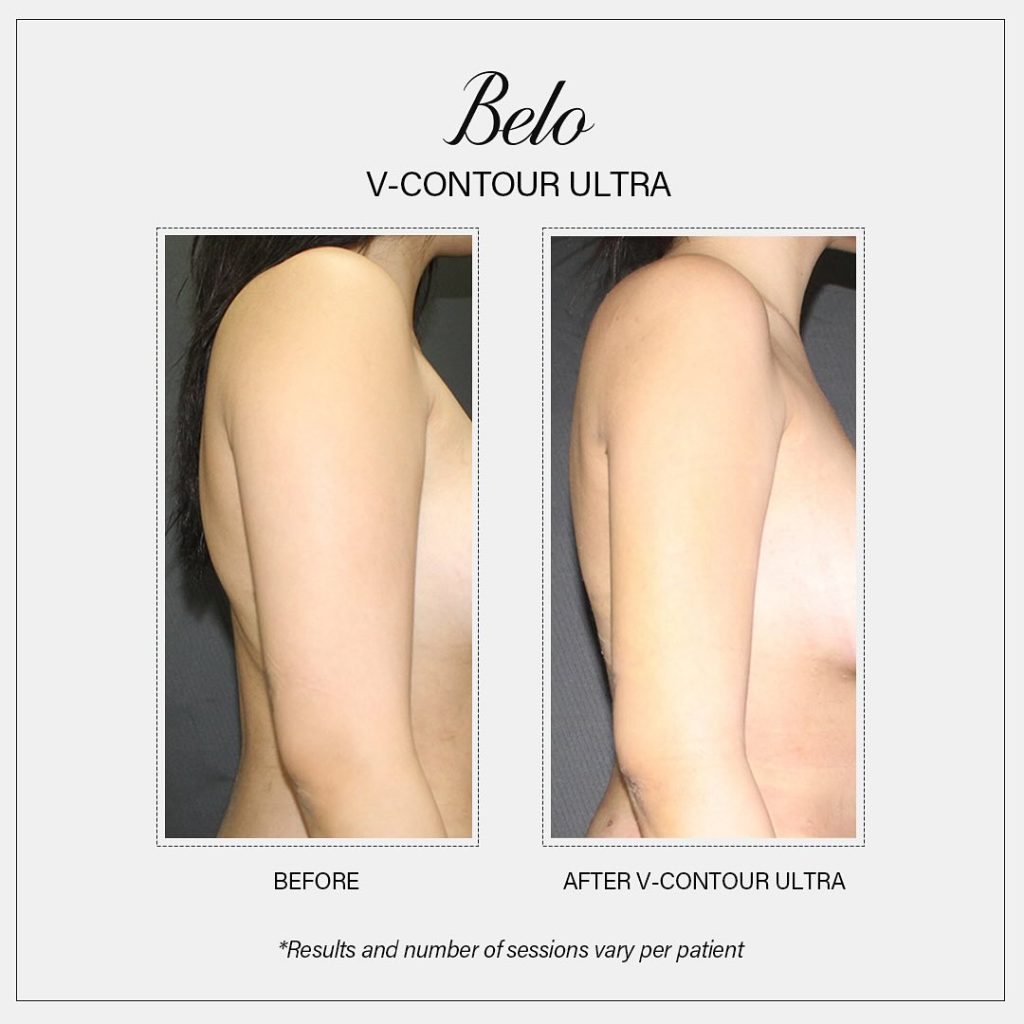 Before and After V Contour Ultra Treatment
