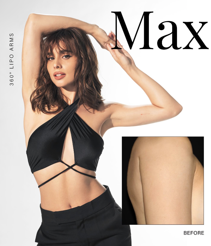 Max Collins with Lipo for Arms