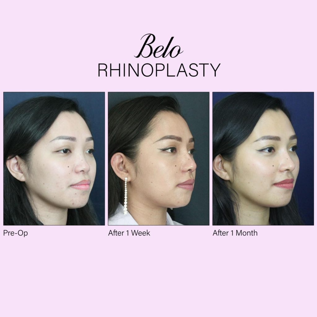 Dr. Tan's rhinoplasty patient
