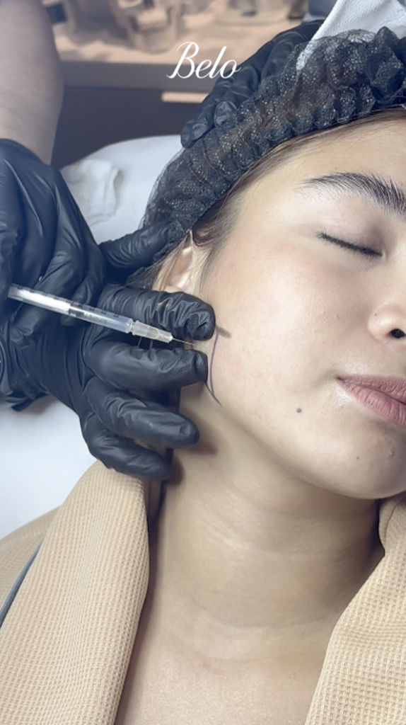 Heaven Peralejo for Belo Botox Masseter treatment