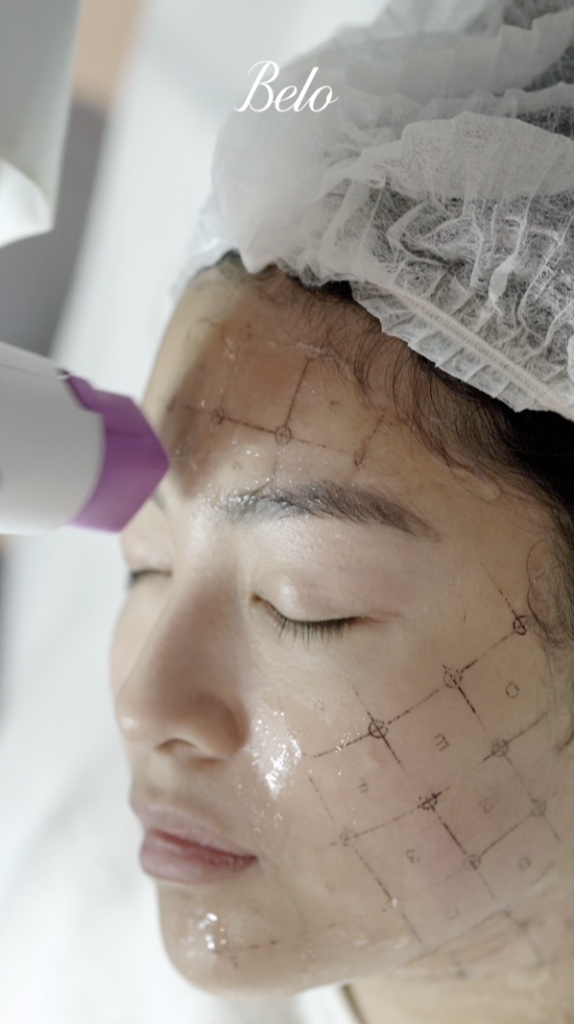 Rei Germar for Belo Thermage FLX treatment