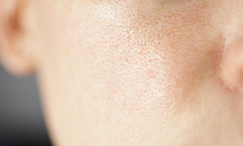 Image shows enlarged pores and poor skin texture.