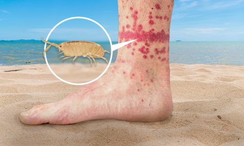 Niknik_Bites_How_To_Treat_&_Avoid_Them_On_Your_Next_Beach_Trip
