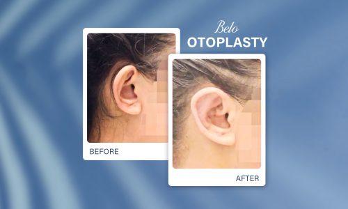 What_Is_Otoplasty_Your_Simple_Guide_to_Ear_Reshaping_Surgery