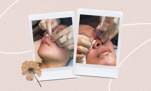 agnes destroy oil glands